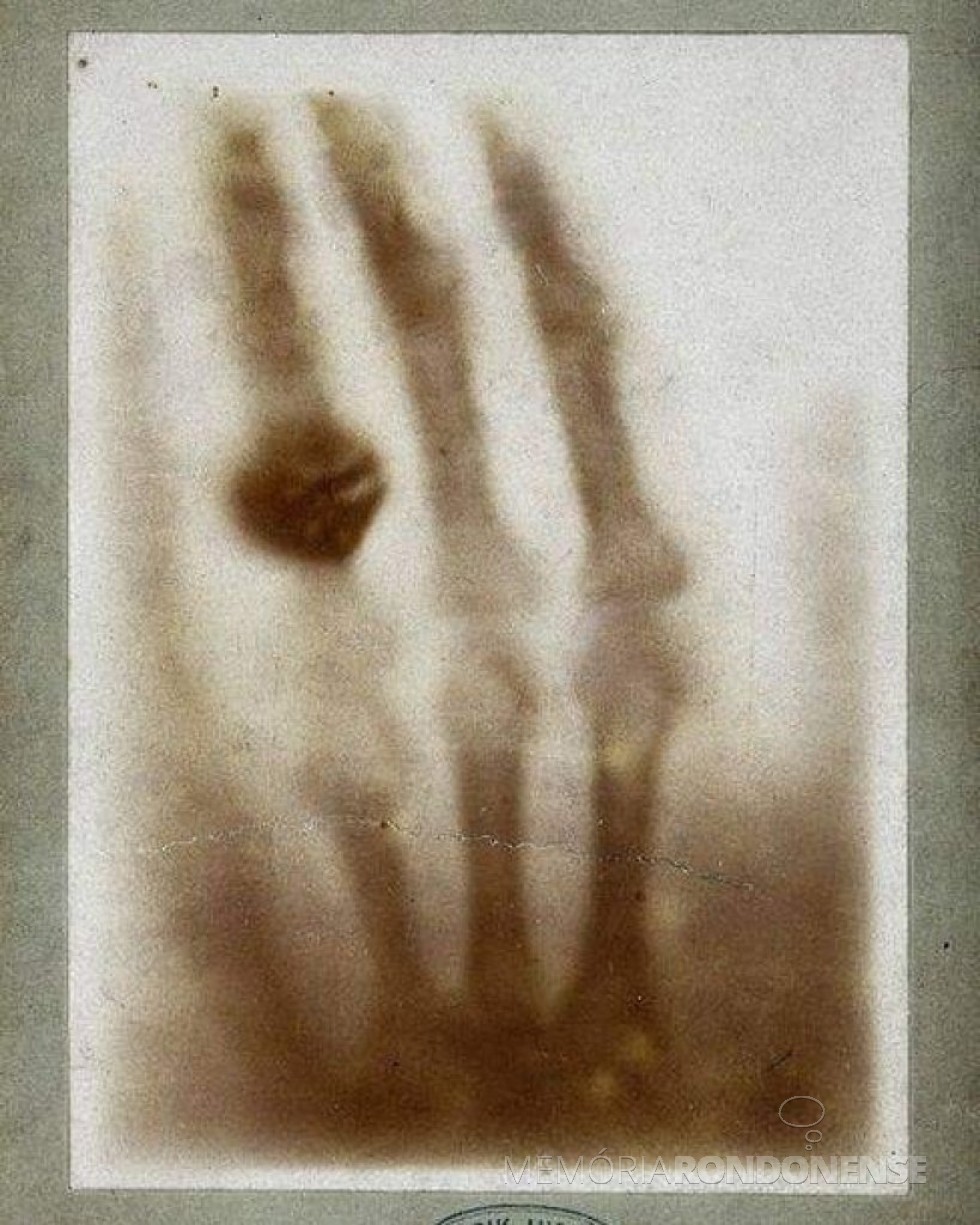 || A memorável imagem do conjunto de ossos da mão esquerda  Ana Bertha Röntgen fotografados via raios X, por seu esposo Wilhelm Conrad Röntgen, em 1895.
Imagem: Acervo German Röntgen Museum - FOTO 4 -
