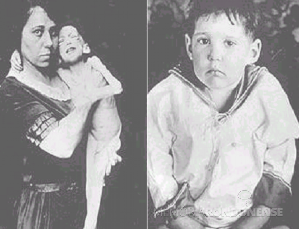 || Adolescente Leonard Thompson antes e depois de receber insulina purificada. 
Imagem: Acervo Abev. org. br - FOTO 2 --